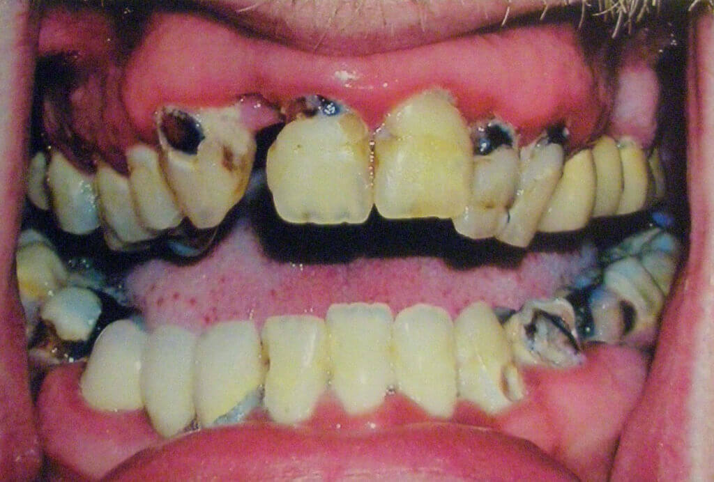 Meth Mouth