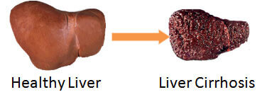 285_LiverCirrhosis