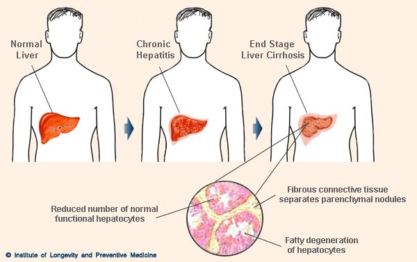 Cirrhosis of the Liver